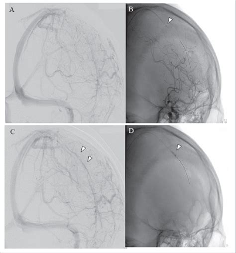 A Left Internal Carotid Angiogram Lateroposterior View Venous