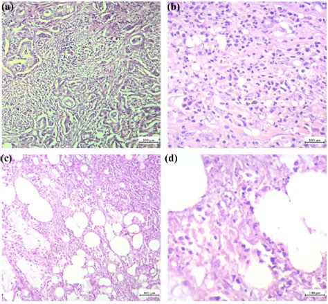 Hematoxylin And Eosin Staining Of Itils In Pancreatic Cancer A X100