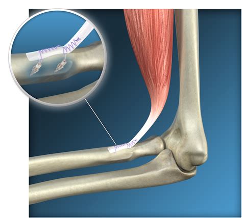 Endoscopic Distal Biceps Reinsertion Surgery Toulouse Rotura Del