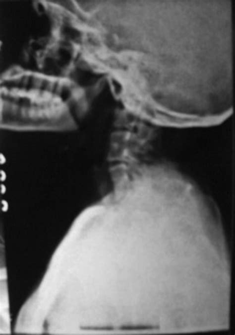 X-ray spine shows a fusion of C2–C3, C4–C5–C6 vertebrae. | Download ...