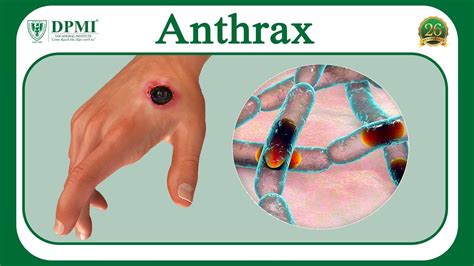 Anthrax What Is Anthrax What Are The Factors Of Anthrax Types Of