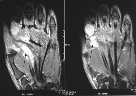 Preoperative MRI. Shown are the schwannoma formations in the area of ...