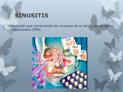 Ppt Sinusitis Powerpoint Presentation Id