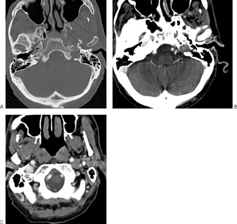 Differential Diagnosis Of Jugular Foramen Lesions Pmc