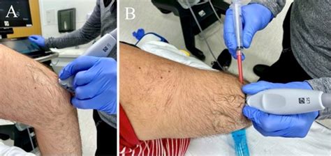 Ultrasound Guided Arthrocentesis Treatment Management Point Of Care