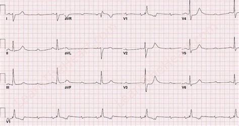 All Ecg Learn The Heart