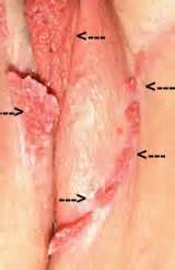 Genital Si Il Kondilom Hpv Resimleri Foto Raflar G R Nt Leri