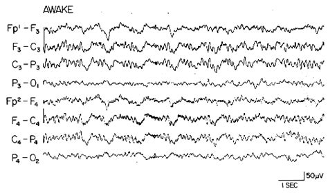 Eeg Is Useful For Diagnosing Alzheimers Disease