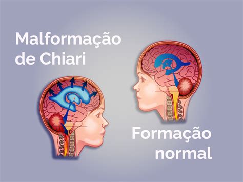 Tudo sobre a Malformação de Chiari Dr Jânio Alves Ferreira