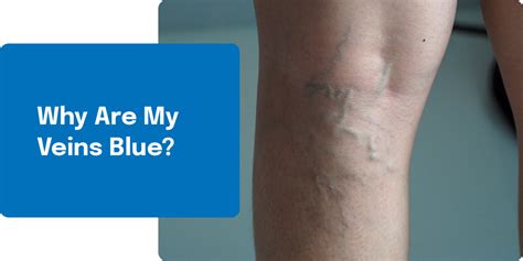 Why Are My Veins Blue? - Texas Vein & Wellness Institute