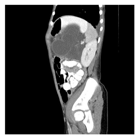 Contrast Enhanced Ct Sagital Scan Shows That Retroperitoneal