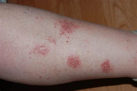 Nummular Eczema Symptoms And Treatment