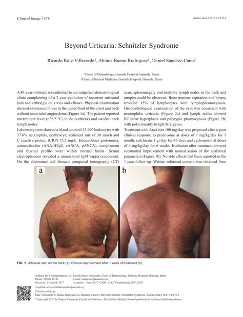 (PDF) Beyond Urticaria: Schnitzler Syndrome