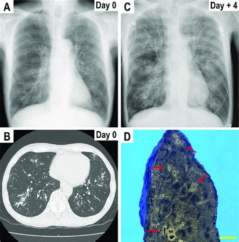 Radiological Images And Macroscopic Findings A Chest Radiograph Upon