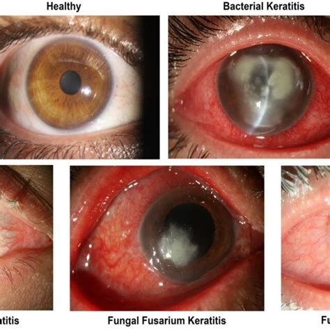 Slit Photo Samples Of Healthy Eye And Different Types Of Keratitis Download Scientific Diagram