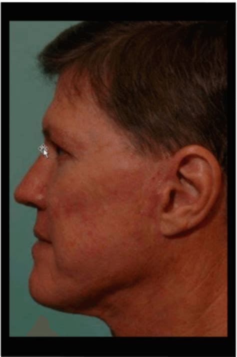 Face Lift Procedure Beeson Cosmetic Surgery