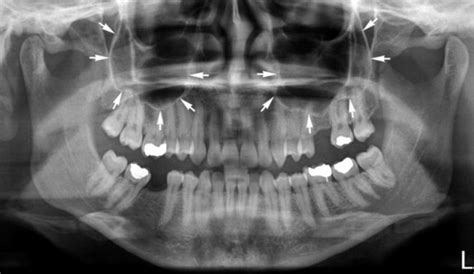 Floor Of Nasal Cavity Radiograph Viewfloor Co