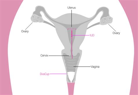 IUDs and the DivaCup | Menstrual & DivaCup Facts