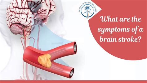 What are the symptoms of a Brain Stroke? - dr.chiraggupta