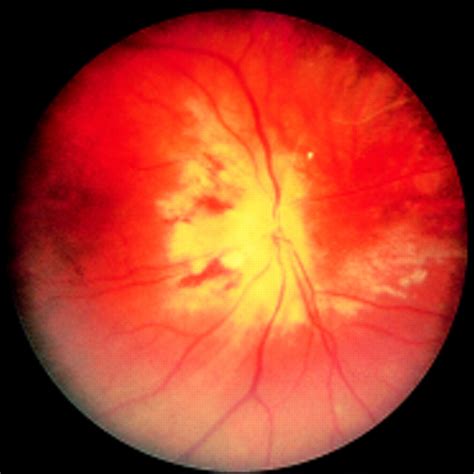 Reliability Of Expert Interpretation Of Retinal Photographs For The