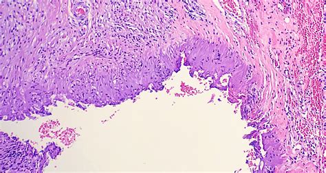 Dermatopathology Histology Artifacts Treatment And Management Point