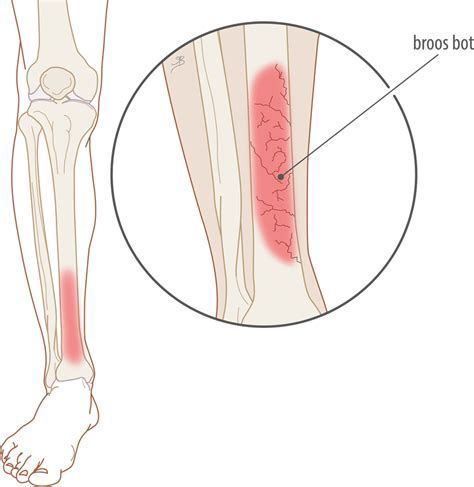 Shin Splints Dr Maarten Moen