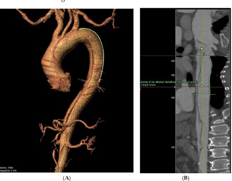 Figure 1 from Sizing the Frozen Elephant Trunk Based on Aortic ...