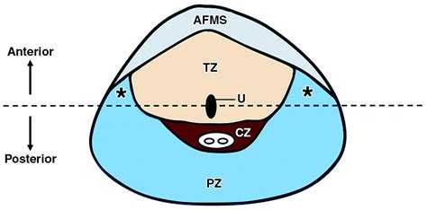 Anterior Prostate Cancer Diagnostic Performance Of T2 Weighted MRI And