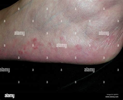 Rash On The Foot Of A Patient With Majocchi S Granuloma This Infection