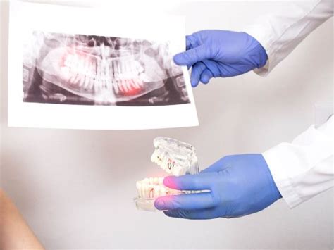 Pulpitis Causas Síntomas y Tratamiento CLINICA DENTAL EL MAITEN