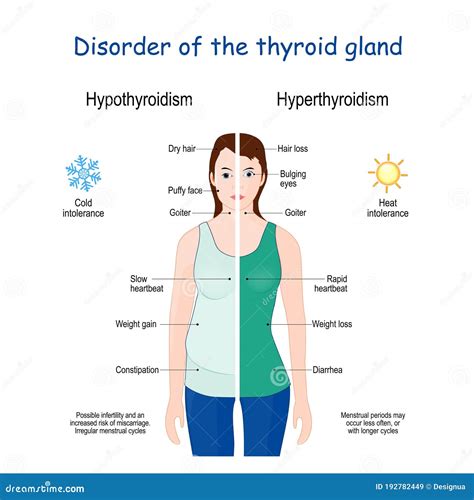 Hyperthyroidism And Hypothyroidism Female With Signs And Symptoms Of | Sexiz Pix