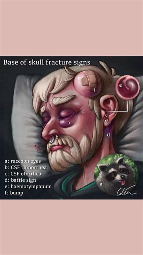 5 Signs Of A Base Of Skull Fracture Artofit