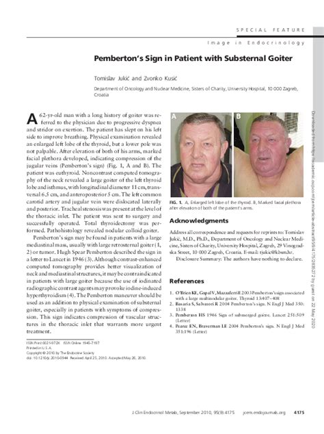 (PDF) Pemberton’s Sign in Patient with Substernal Goiter | Tomislav ...