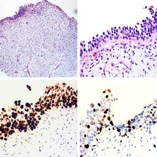 Histological Findings Of The Biopsy Sample A Low Power View Showed A