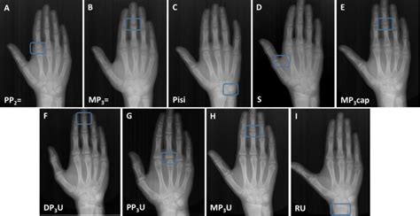 Stages Of Maturation According To The Hand Wrist Radiographs A Pp