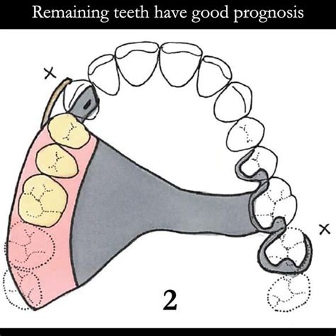 Universal Scandinavian partial denture designs | Finlay Sutton - Denture Education