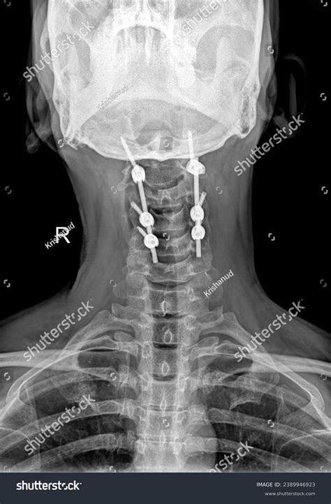 Cervical Spine Cspine Fracture Fixation Captured Stock Photo 2389946923 | Shutterstock