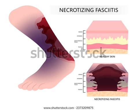 Diabetic Foot Bacteria Infection On Skin Stock Vector (Royalty Free ...