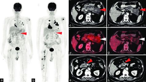 F Fdg Pet Ct Scan On Pazopanib Mip A Transaxial Cect And Fused