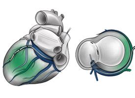 Crt Cardiac Resynchronisation Therapy Wecam