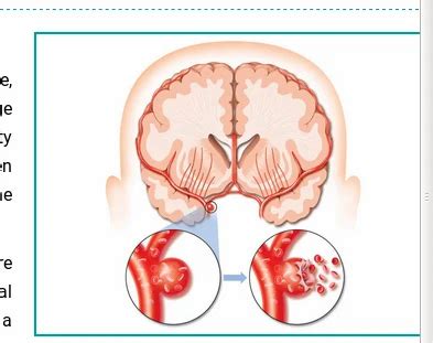 Brain Hemorrhage in Jaipur | ID: 18751759712