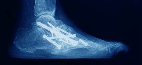 Ankle Fusion Arthrodesis Surgery Procedure And Recovery Wupdoc