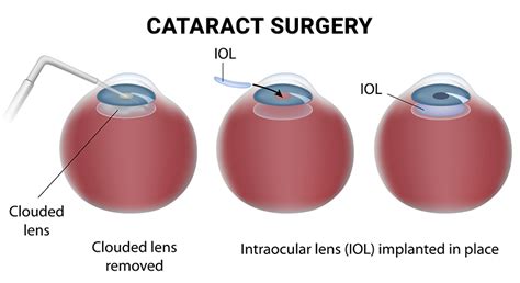 Cataract Surgery NYC | Сataract EYE Treatment in New York