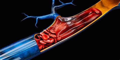 Pulmonary thrombosis Free Stock Photos, Images, and Pictures of ...