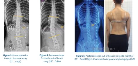 Case 13 Year Old Female Adolescent Patient ScoliBrace