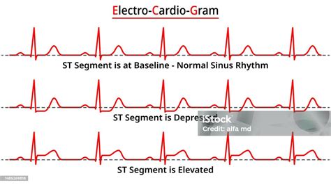 Set Of Ecg Common Abnormalities Elevated St Segment Vs Depressed St