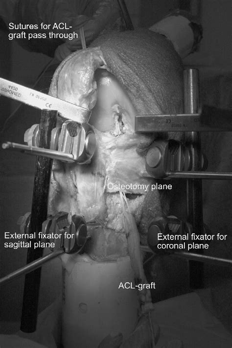 Figure From Effect Of Slope And Varus Correction High Tibial