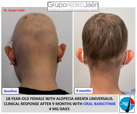 Baricitinib Efectividad Y Duraci N Del Tratamiento Para La Alopecia