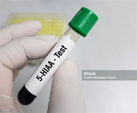 Blood Sample For 5hiaa Test Stock Photo - Download Image Now - iStock