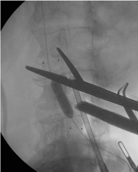 Figure 2 From New Development For Aorto Bifemoral Bypass A Clampless And Sutureless